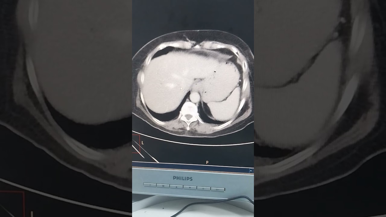 #CT_BODY أشعه مقطعيه علي البطن والحوض