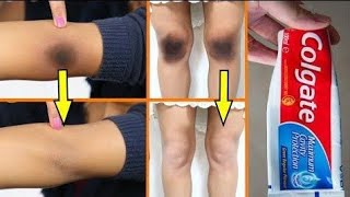 Madmadowga Jilbaha Iyo Luqunts Sifud Isakabihiremove Black Knees Uderarm In Just A Minute