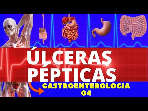 Vídeo: Úlcera Péptica: Causas, Tratamento E Prevenção