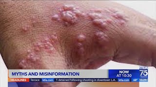 Debunking myths and misinformation surrounding Monkeypox