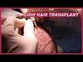 Dhi hair transplant all proces  which technique is right for you