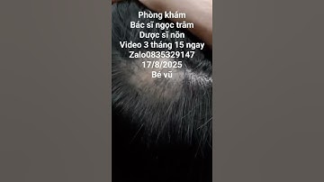 rụng tóc mảng. bé vũ 14 tuổi. video 3 tháng 15 ngày #toctoc