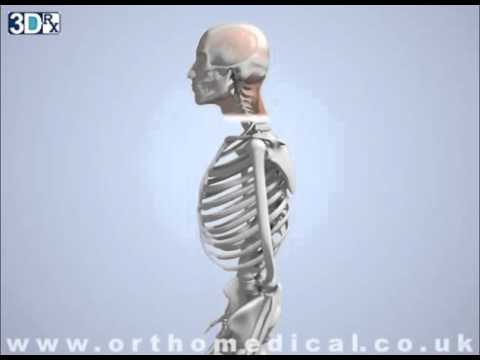 أمراض العمود الفقري القعس 