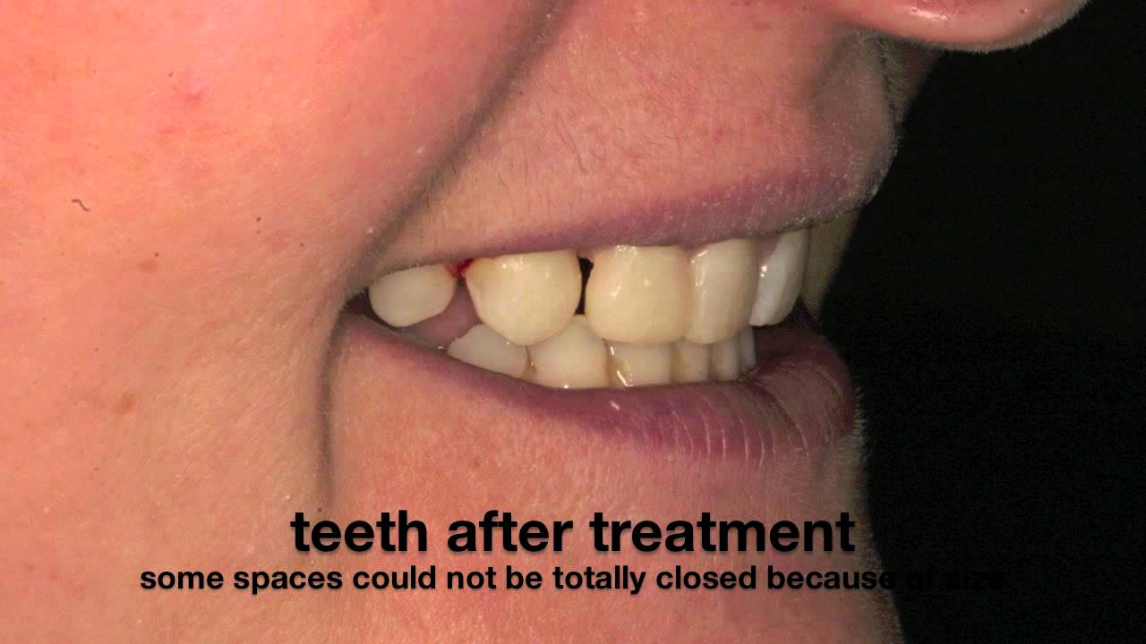 Cosmetic Dentistry With Composite Resin Bonding YouTube