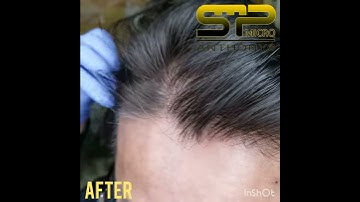 Scalp Micropigmentation for thinning hair increasing hair density