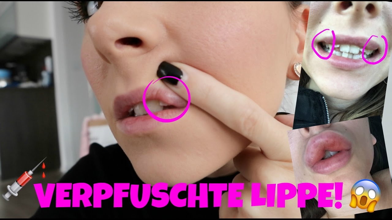 Lippen Aufspritzen Ist Schiefgegangen Verpfuschte Lippe Was Nun Meine Erfahrung Youtube