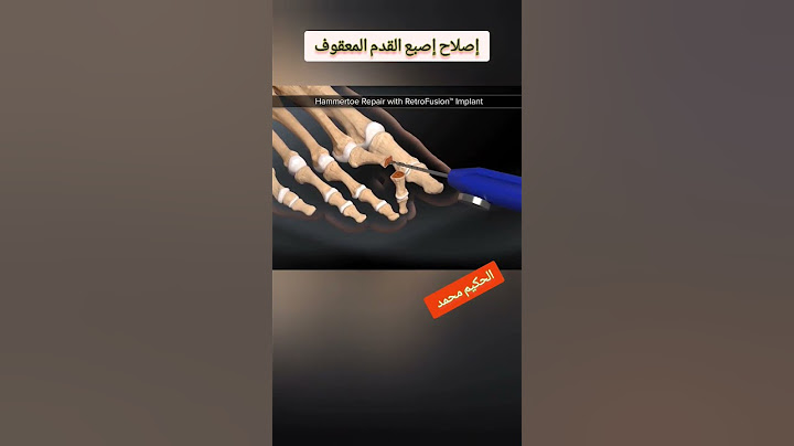 اصلاح اصبع القدم المطرقية