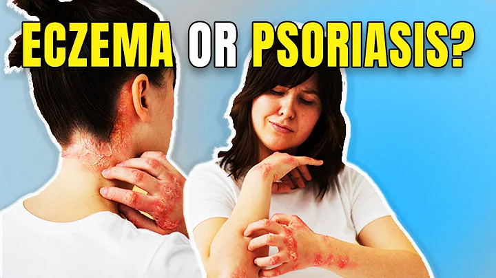 Why Do You Have Psoriasis or Eczema | What Causes Itchy Skin & How to Treat