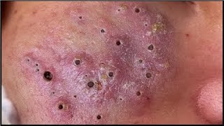 Big Blackheads Removal, Acne Treatment, Spa Asmg, Blackheads On Face