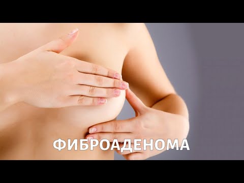 Video: Krūts Fibroadenoma: Cēloņi, Simptomi Un Diagnostika