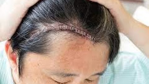 Craniectomy CPT code - simplify medical coding