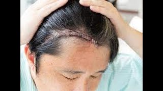 Craniectomy CPT code - simplify medical coding