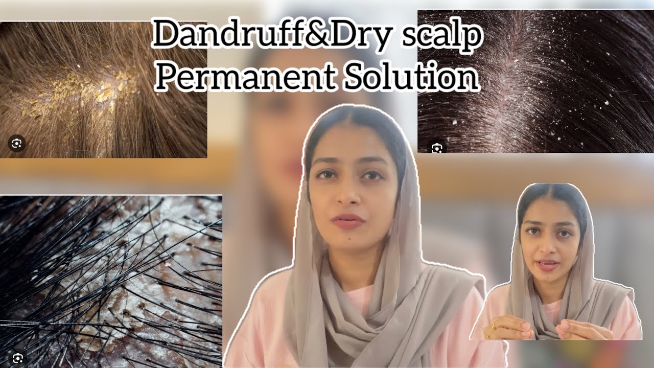 Permanent Solution For Dandruff&Dry Scalp✨Malayalam 