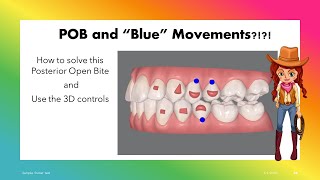 Invisalign ClinCheck - Solve Posterior OpenBite with 3D controls!