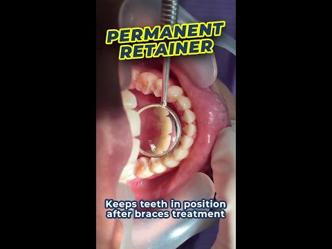 Permanent Teeth Retainer