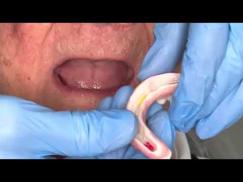 Digital Dentures: Upper