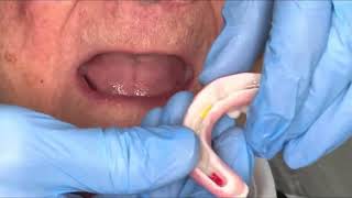 Digital Dentures: Upper Milled Complete Denture - Lower 3D Printed Bar OverDenture