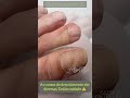 Unhas dos pés amareladas, grossas e ocas 😵😵😵