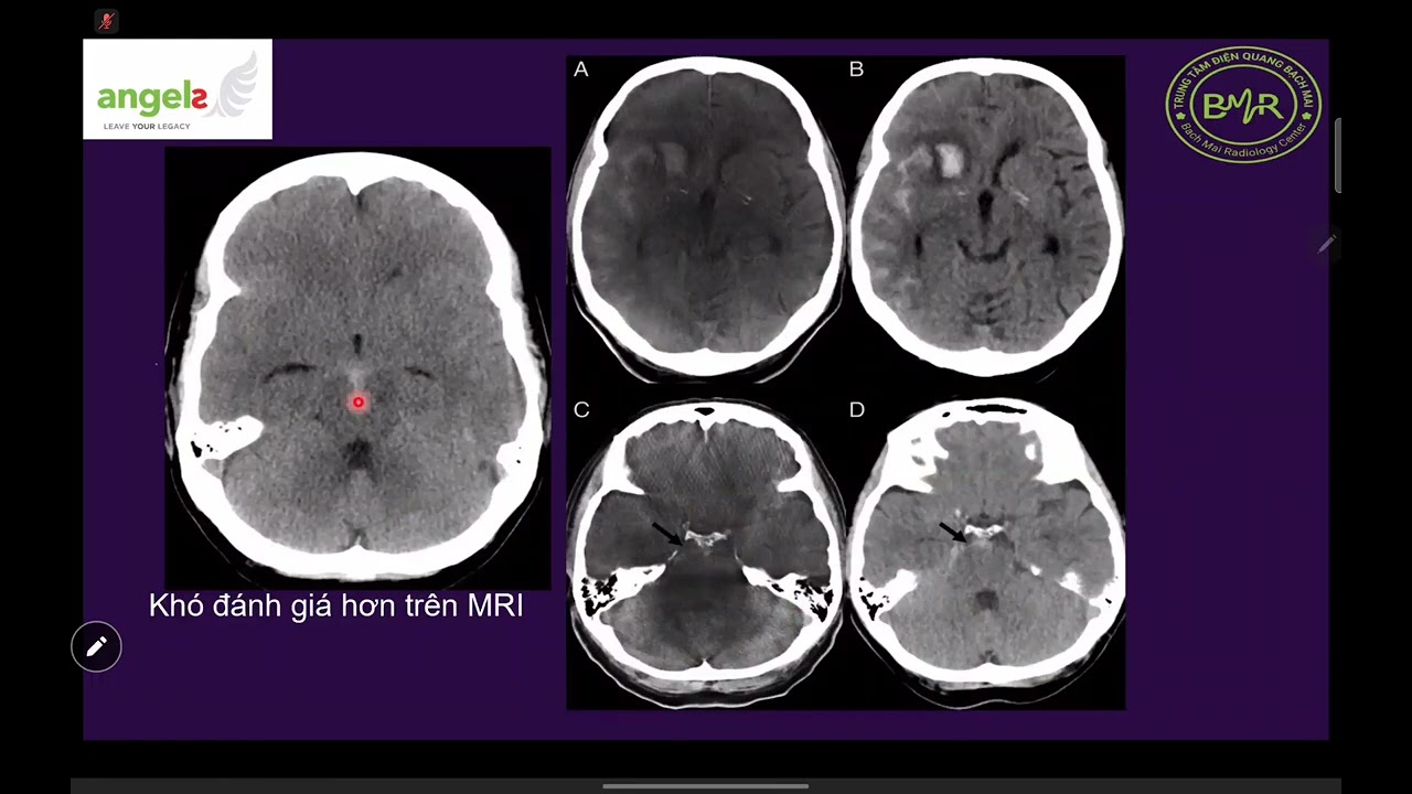 CĐHA đột quỵ não TS Quang Anh
