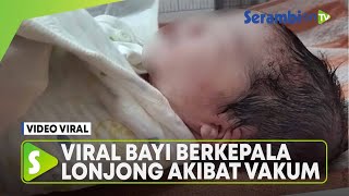 VIRAL Bayi Berkepala Lonjong akibat Vakum saat Proses Persalinan, Begini Penjelasan Dokter