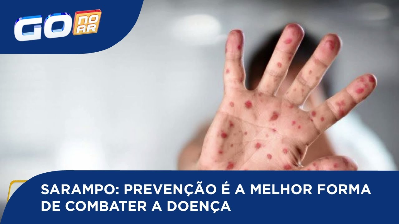 Como Eram Feitas As Primeiras Ações De Prevenção Do Sarampo