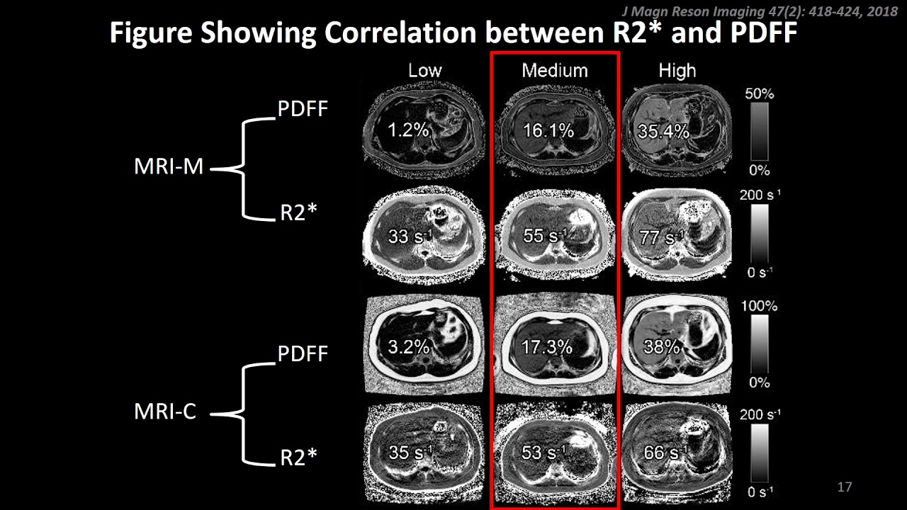 Adrija Mamidipalli - Cross-sectional relationship between hepatic PD FF and hepatic R2* with NAFLD
