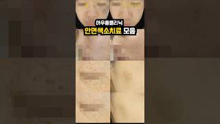 안면색소치료 모음 #문신제거 #타투제거