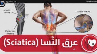 عرق النسا: الأسباب والعلاجات المثبتة علمياً #عرق_النسا #sciatica