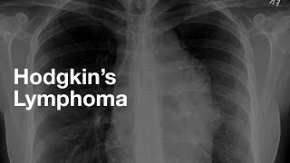 Classic Case: Hodgkin's Lymphoma