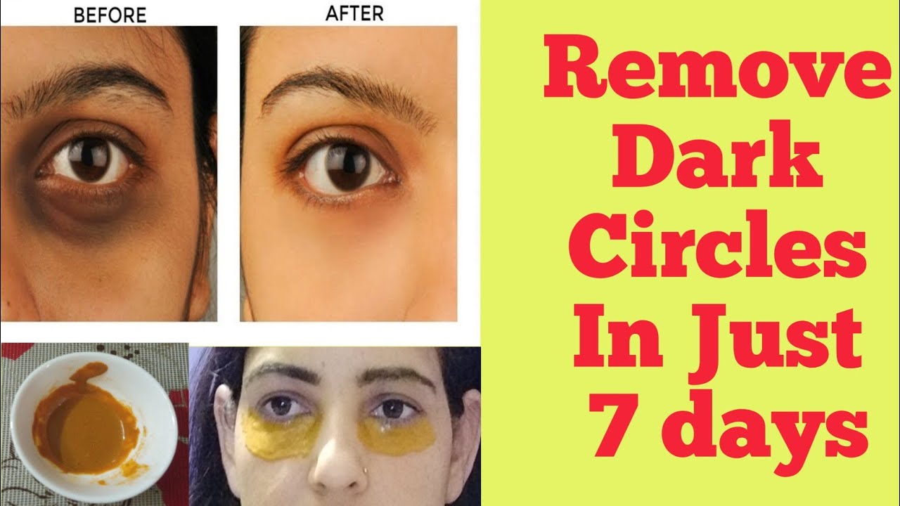 19 Ways To Remove Dark Circles