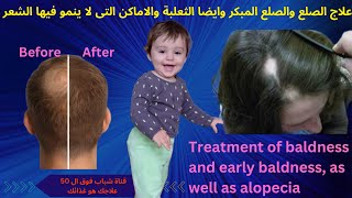 علاج الصلع والثعلبة بأقل مجهود-فكر جديد -نتائج مضمونة ومجربة- Treatment of baldness and alopecia