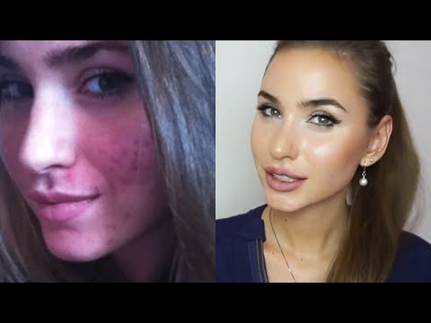 Уход За Проблемной Кожей Лица