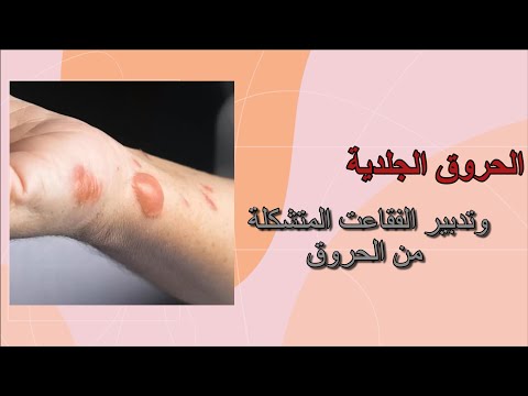حروق الجسم حيلة مذهلة للتعامل مع حروق الدرجة الثانية