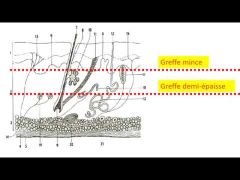 Vidéo: Greffe De Peau: Objectif, Types Et Procédure