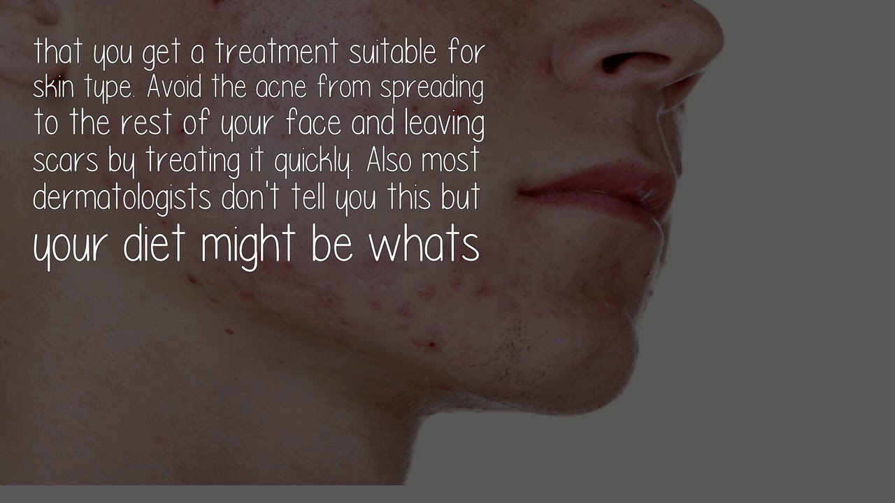 can-i-see-a-dermatologist-on-the-nhs-for-my-acne-youtube