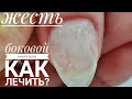 Онихолизис/Боковой онихолизис/Травматическое отслоение ногтей/Как лечить онихолизис/Шулунова Дарья