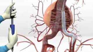 Simulacion Stent Endurant AAA de Medtronic