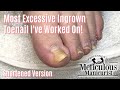 👣Most Extreme Ingrown Toenail Salon Pedicure - Shortened 👣