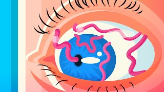 Scientists Shocked By Worms Breeding Inside People's Eyes