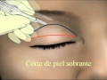 BLEFAROPLASTIA O CIRUGIA DE PARPADO SUPERIOR  * INNOPLASTICA*