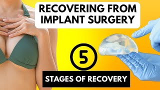Breast Implant Recovery - 5 Stages