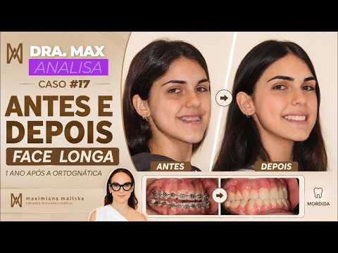 Dr. Max Analyzes | Case #17 | Long Face, Class III Bite and Gummy Smile