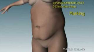3D Animation - Anchor Lipoabdominoplasty: a Three-layer technique