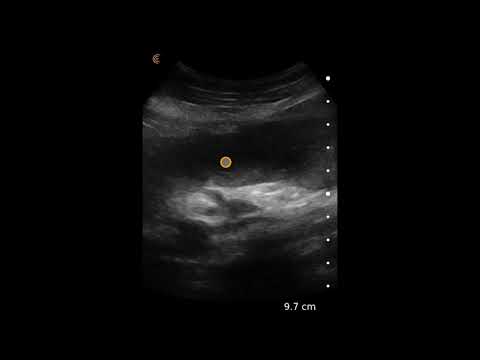 Small Bowel Obstruction