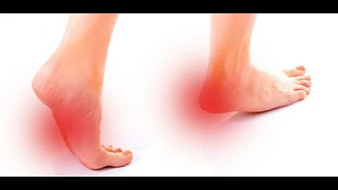 ¿Caminar de puntillas es bueno para la fascitis plantar?