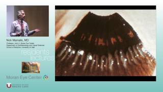 Glaucoma Pathology [ARCHIVE]