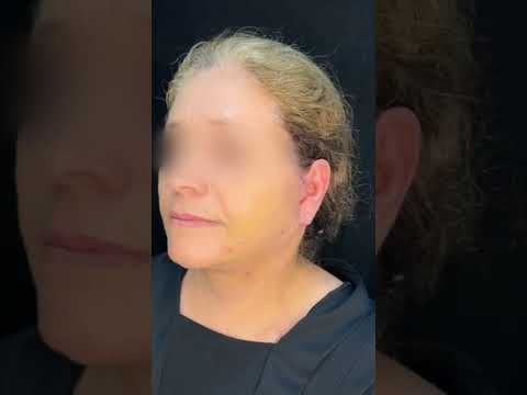 عملية شد الوجه و الرقبة تخدير موضعي دكتورة رسل طارق اخصائيه الجراحه التقويميه والتجميليه تجميل
