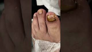 ASMR Pedicure Tutorial Shorts ingrown pedicure toenail youtubeshorts (5)