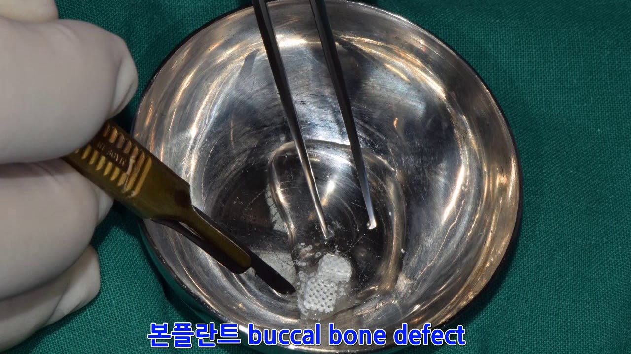 Buccal Bone Dedect  본플란트 에스겔의 BONEPLANT