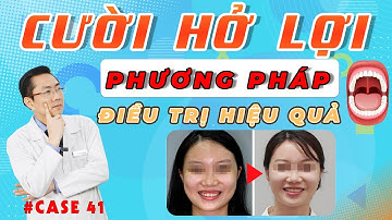 Niềng Răng Chữa Cười Hở Lợi | Cách Điều Trị Dứt Điểm Không Cần Phẫu Thuật